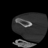 SPORK, NICO - 22.03.1976 - 02.08.2022 - CT obere Extremität - 17:51:17